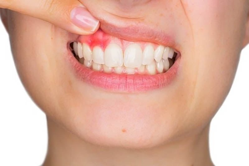 Ăn gừng có thể giúp điều trị nhiều bệnh lý về răng miệng
